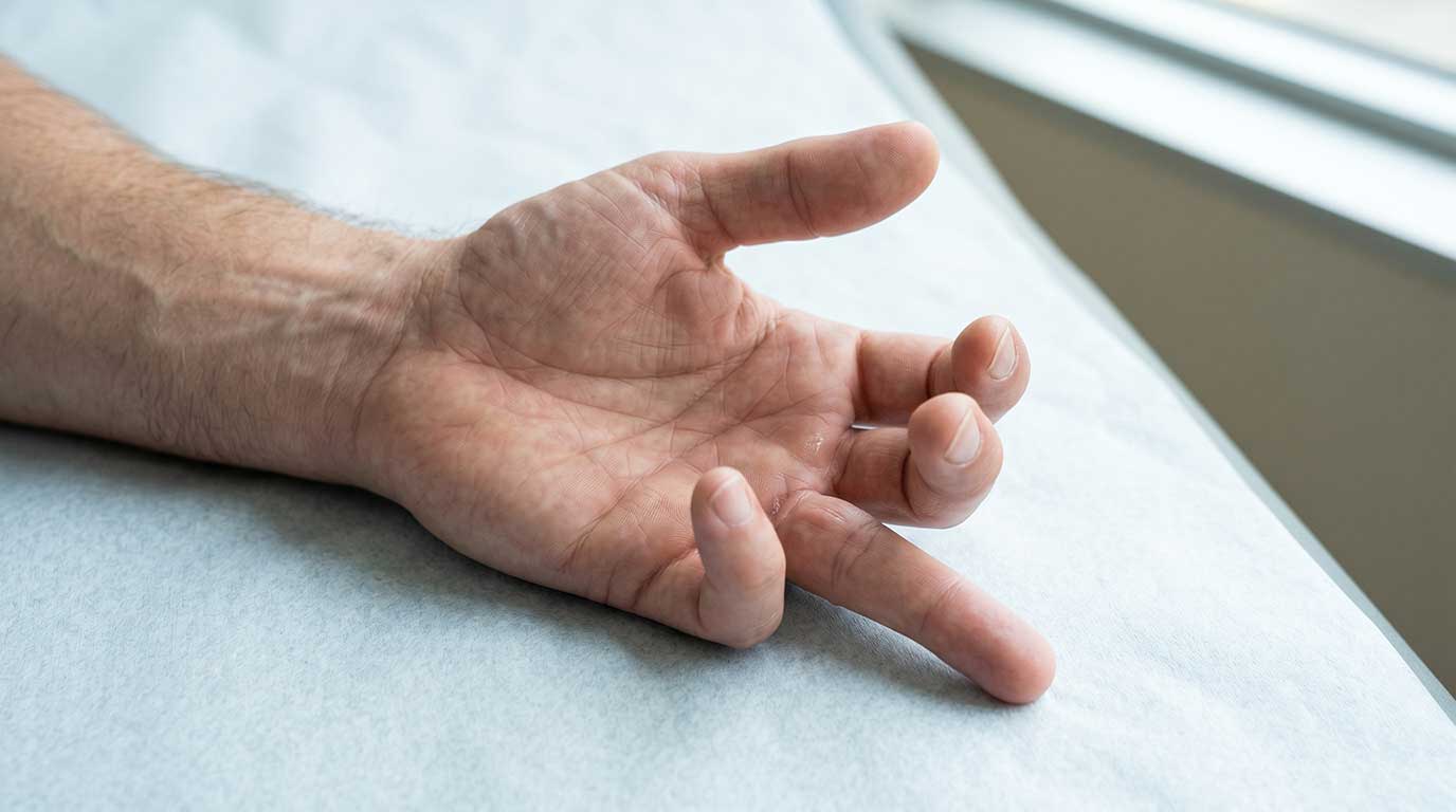 Lesiones de tendones flexores de mano: Causas, tratamiento y rehabilitación